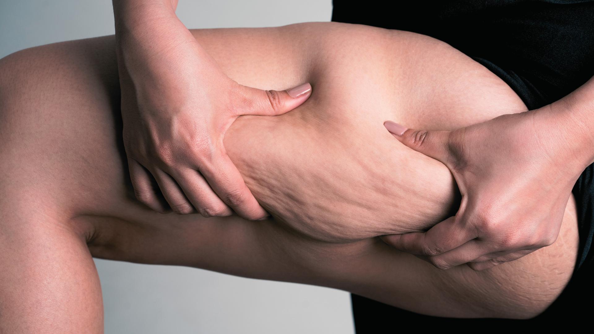 Cellulite : comment raffermir sa peau naturellement ? - Naturals&co