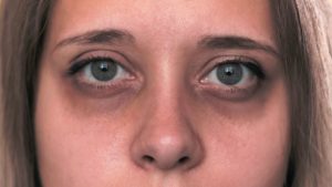 Les cernes: tout ce qu'il faut savoir - Naturals&co